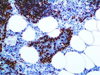 IHC of TdT Rpab on an FFPE Lymphoblastic Lymphoma Tissue
